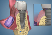 Attached Gingiva Around Implants